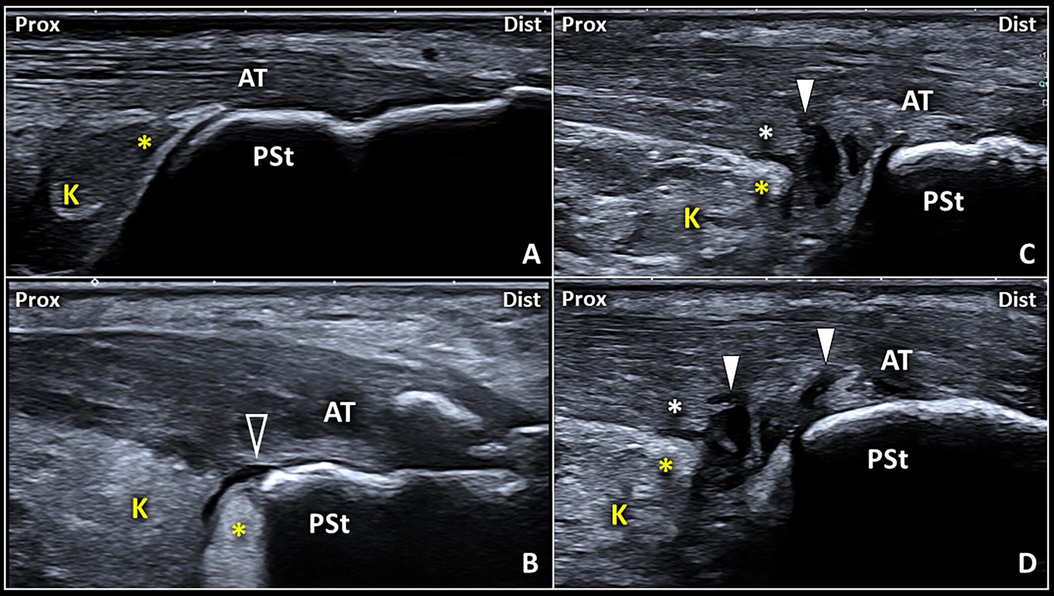 Bursa retrocalcanea 7 Tempo Formacion ecografia.jpg